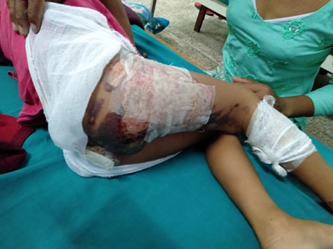 आर्थिक अभावका कारण ४ बर्षीया निर्मला चेपाङकाे उपचारमा समस्या